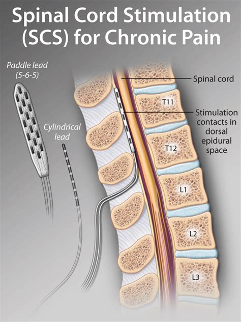 Spinal Cord Stimulation: An Under-utilized and Under-recognized Pain ...