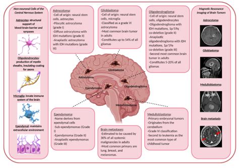 Malignant Brain Tumors | Encyclopedia MDPI