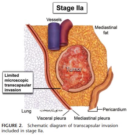 Radiotherapy Dictionary: Thymoma and thymic carcinoma staging systems