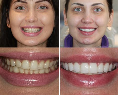 Porcelain Veneers & Bonding in London UK | Cosmetic Dentist