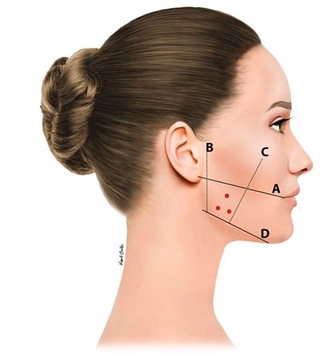 Masseter Botox - Jawline Slimming & Pain Relief Guide