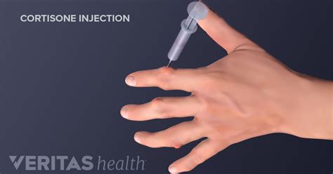 Cortisone Injection Risks and Side Effects