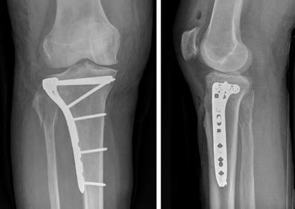 Anterior Tibial Plateau Fracture