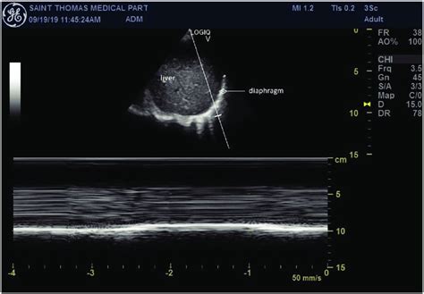 Point-of-care ultrasound of the right hemi-diaphragm in the... | Download Scientific Diagram