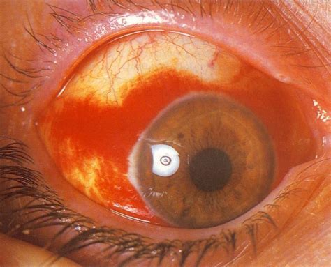 http://www.clinicaoftalmologicanebro.com: Hemorragia subconjuntival