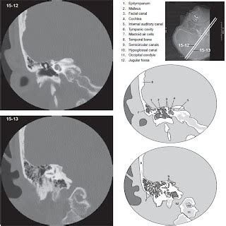 Temporal Bone - CT Scan - RadTechOnDuty