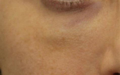 Solution: Puffy Under Eyes After Filler Injection | Dr. Brett Kotlus, Cosmetic Oculoplastic ...