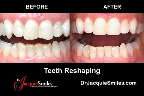 Tooth Reshaping and Dental Contouring in NYCDr. Jacquie