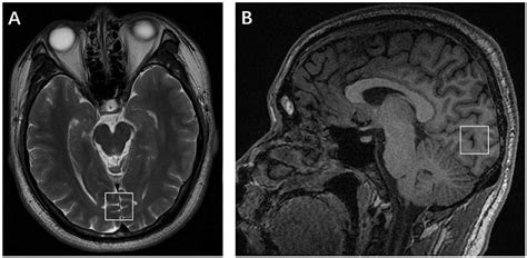 Frontiers | Altered Metabolites in the Occipital Lobe in Migraine Without Aura During the Attack ...