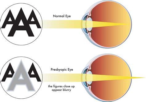 Presbyopia Treatment & Surgery | Toledo LASIK