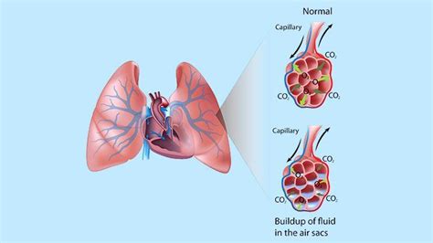 Pulmonary Edema: Symptoms, Diagnosis, Prevention