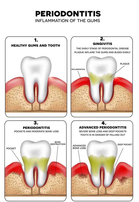 What Causes Periodontal Disease - Bacterial Infection