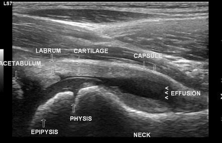 Transient synovitis of the hip | Radiology Case | Radiopaedia.org