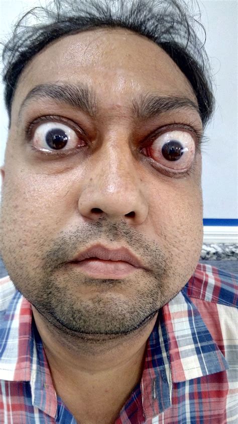 Exophthalmic - Definition of Exophthalmic