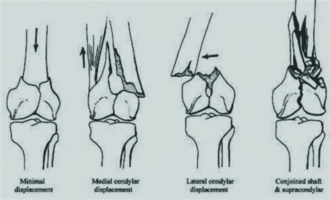 Classification of Distal Femur Fractures and Their Clinical Relevance ...