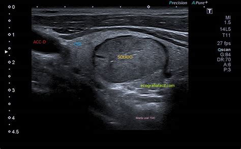 208. Clasificación Ti-Rads. Nódulos tiroideos. – Ecografía Fácil