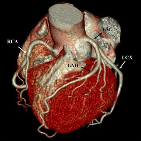 A male diabetic patient with multi-vessel disease. A, Volume rendering ...