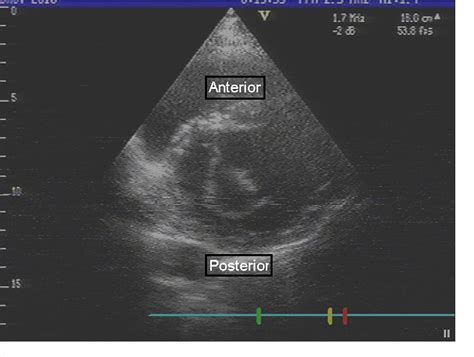 Figure 1 from Isolated cleft of the anterior mitral valve leaflet ...