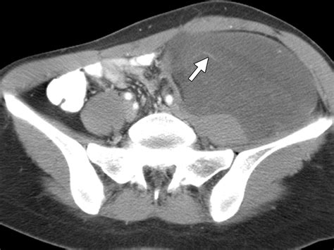 Imaging of Uncommon Retroperitoneal Masses | RadioGraphics