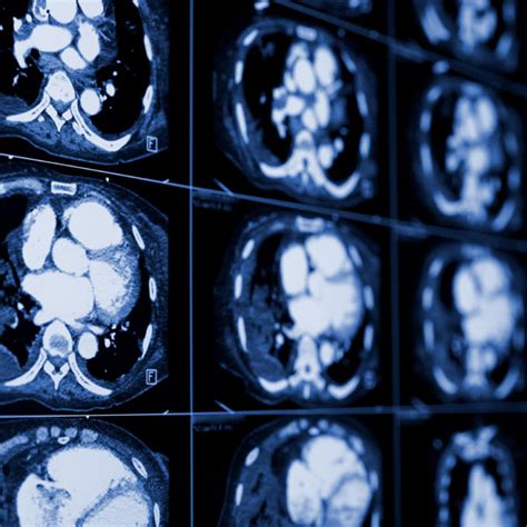 Radiation Levels: Radiation Levels Mri Vs Ct Scan