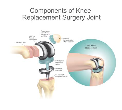 3 Reasons to Avoid – or Delay – Knee-Replacement Surgery - | - thirdAGE