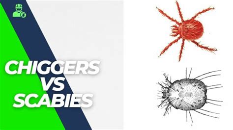 The Complete Guide To Chiggers Vs Scabies! | Y-L-P-C