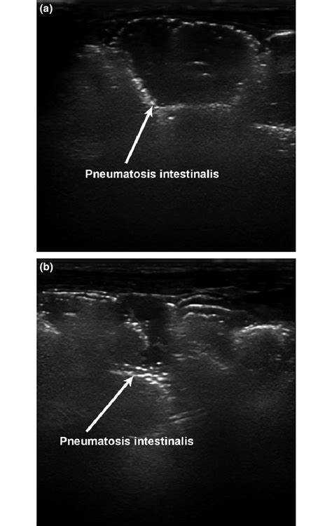 (a, b) Demonstration of Intramural Gas (Pneumatosis Intestinalis) on... | Download Scientific ...