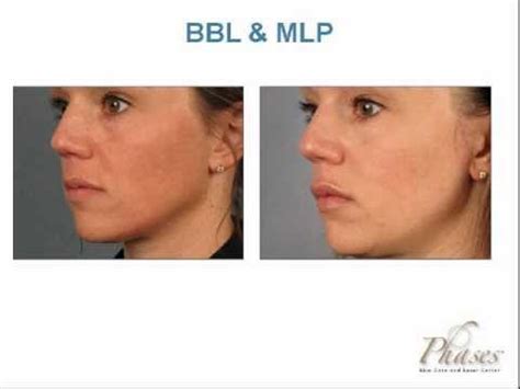 Sciton Laser Treatments - YouTube