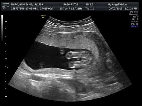 Help! Confusing gender reveal ultrasound! **Update at 20 weeks ...