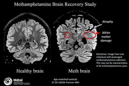 Can brains bounce back? Recovering addicts turn to science to map the effects of meth | New ...