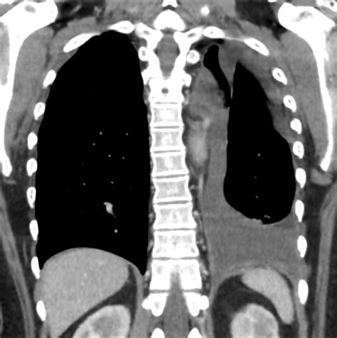 187Lu Loculated Pleural Effusion | Lungs