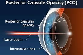 YAG Laser Procedure After Cataract Surgery - Columbia Eye