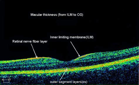 Retinal nerve fiber layer of OCT. | Download Scientific Diagram