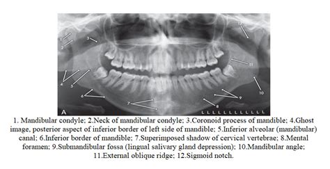 Submandibular Fossa Radiograph