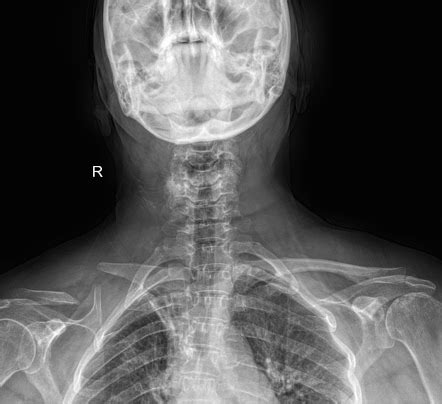 Clavicle fracture non-union | Radiology Case | Radiopaedia.org