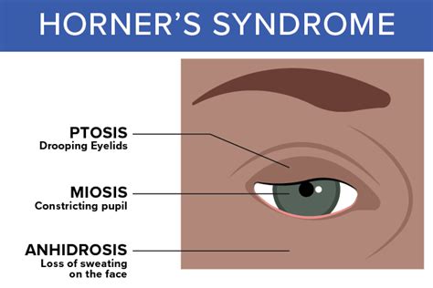 Horner’s Syndrome: Causes, Symptoms, Treatments