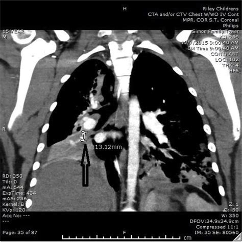 CT chest showing calcified granuloma in the right lung. | Download ...