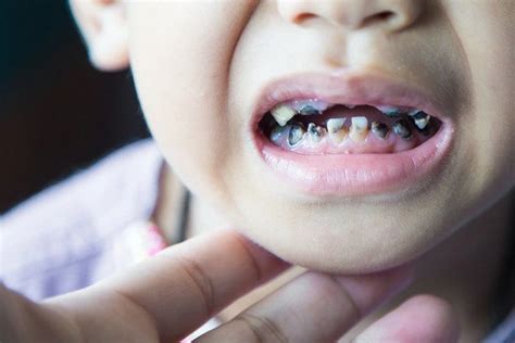 Tooth Decay in Children - Causes, Treatment & Prevention