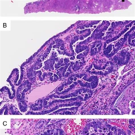 Serous endometrial intraepithelial carcinoma (SEIC) localized to a... | Download Scientific Diagram