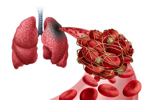 Study: Death rate from lung clots is on the rise after years of decline | NHLBI, NIH