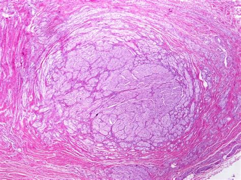 Neuroma Histology