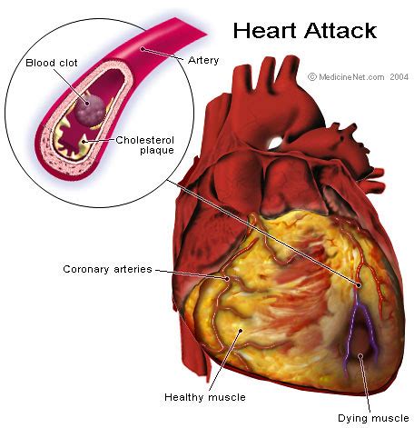 heart attack anatomy | heart attack-- how the blood clot blo… | Flickr