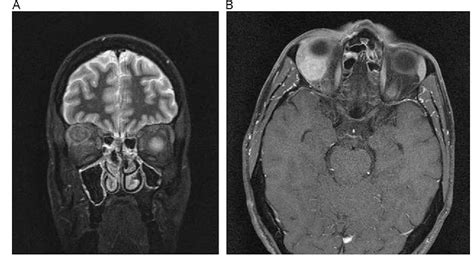 Figure 2 from IgG4-related orbital disease mass lesion. | Semantic Scholar