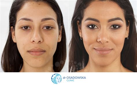 Real photos Upper eyelid laser surgery, before and 6 months after - Dr Osadowska Clinic Poland