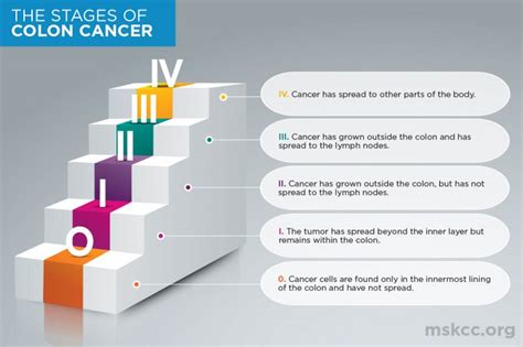 Stages of Colon Cancer | Memorial Sloan Kettering Cancer Center