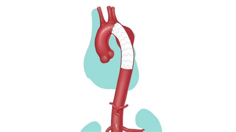 Thoracic Endograft: Relining the Aorta to Prevent Rupture of a Thoracic ...