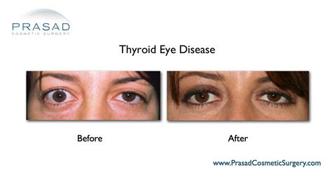 Thyroid Eye Disease Surgery/ Graves Eye Disease Surgery | Dr. Prasad