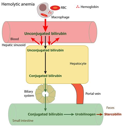 Bilirubin in a hemolytic anemia | eClinpath