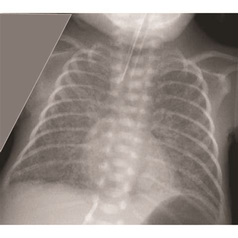 (a) CXR shows linear lucencies suggestive of PIE in both lungs on 6th ...