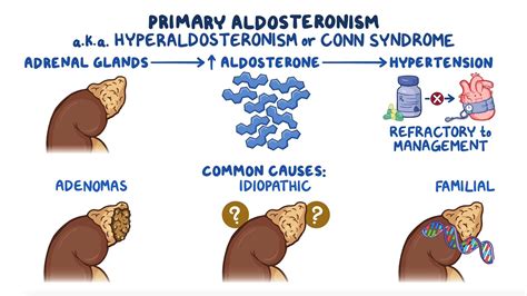 Primary aldosteronism (hyperaldosteronism): Clinical sciences - Osmosis ...